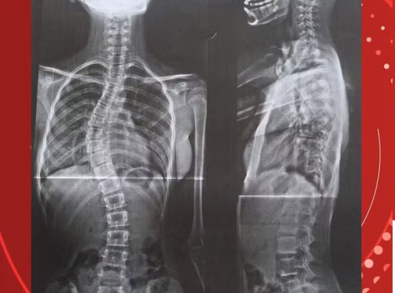 13/10/26  Após enfrentar o governo, mãe consegue cirurgia para filha com coluna em formato de 'S' em RO